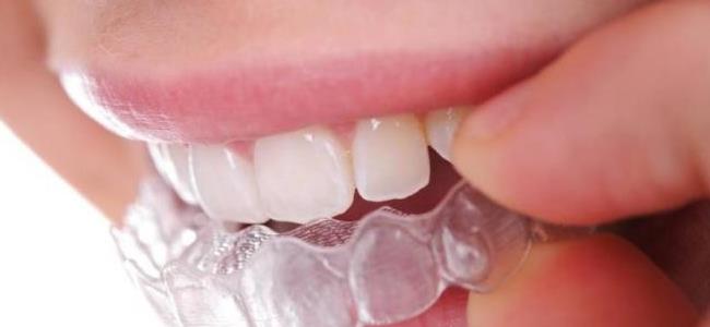 كل ما يجب أن تعرفوه عن تقويم الأسنان المتحرك