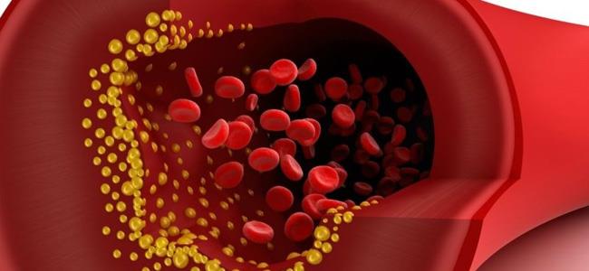 دراسة : زيادة نسب الكوليسترول في الدم تؤدي الى هشاشة العظام