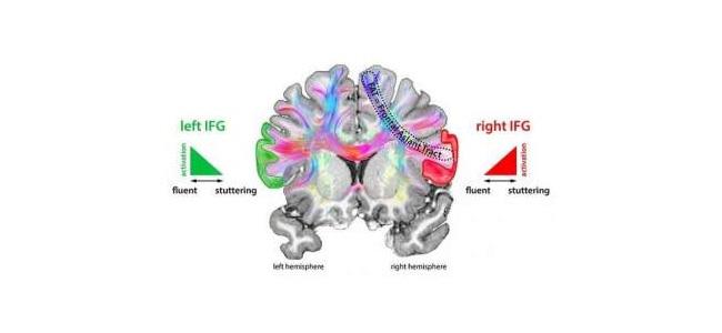 علماء ألمان يكتشفون سبب التأتأة عند الاولاد