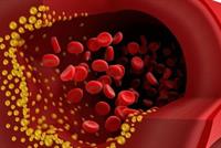 دراسة : زيادة نسب الكوليسترول في الدم تؤدي الى هشاشة العظام